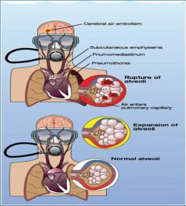 pulmonary barotrauma treatment